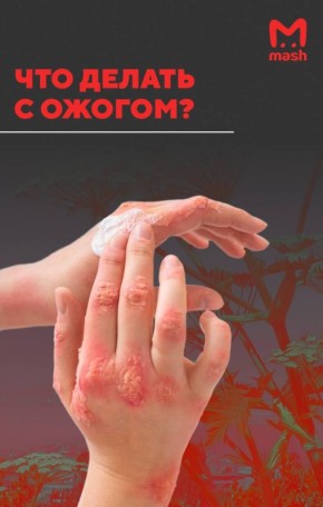 Ожог на коже можно получить от контакта с растениями