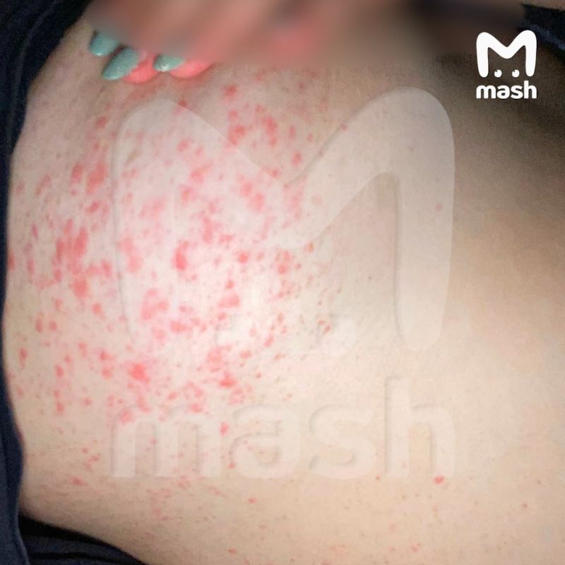 Популярные у девочек-подростков китайские кремы для увеличения груди буквально сжигают кожу — зумерки на 30% чаще приходят с воспалениями, дерматитом и сыпью к врачам