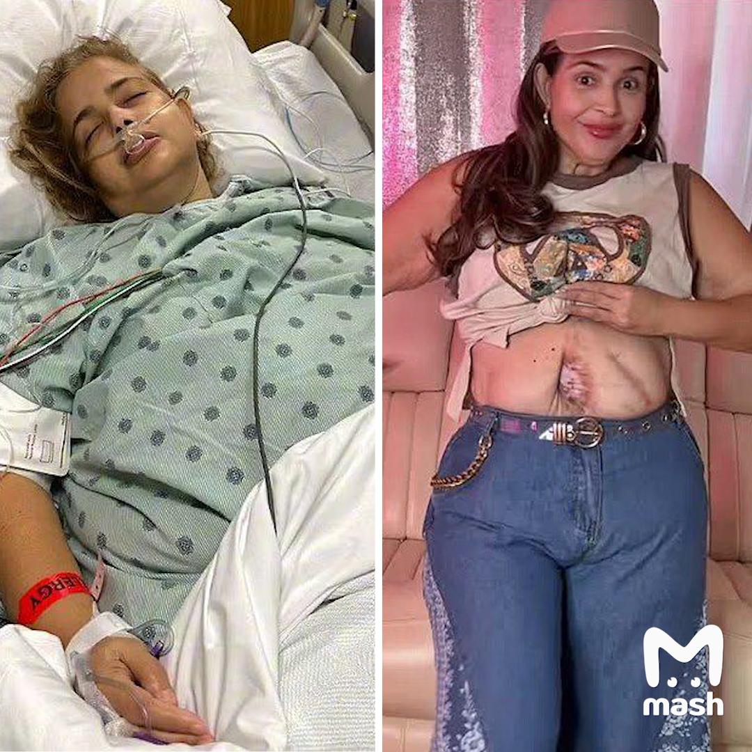 Бодипозитивщица из Венесуэлы осталась без внутренних органов после резекции желудка