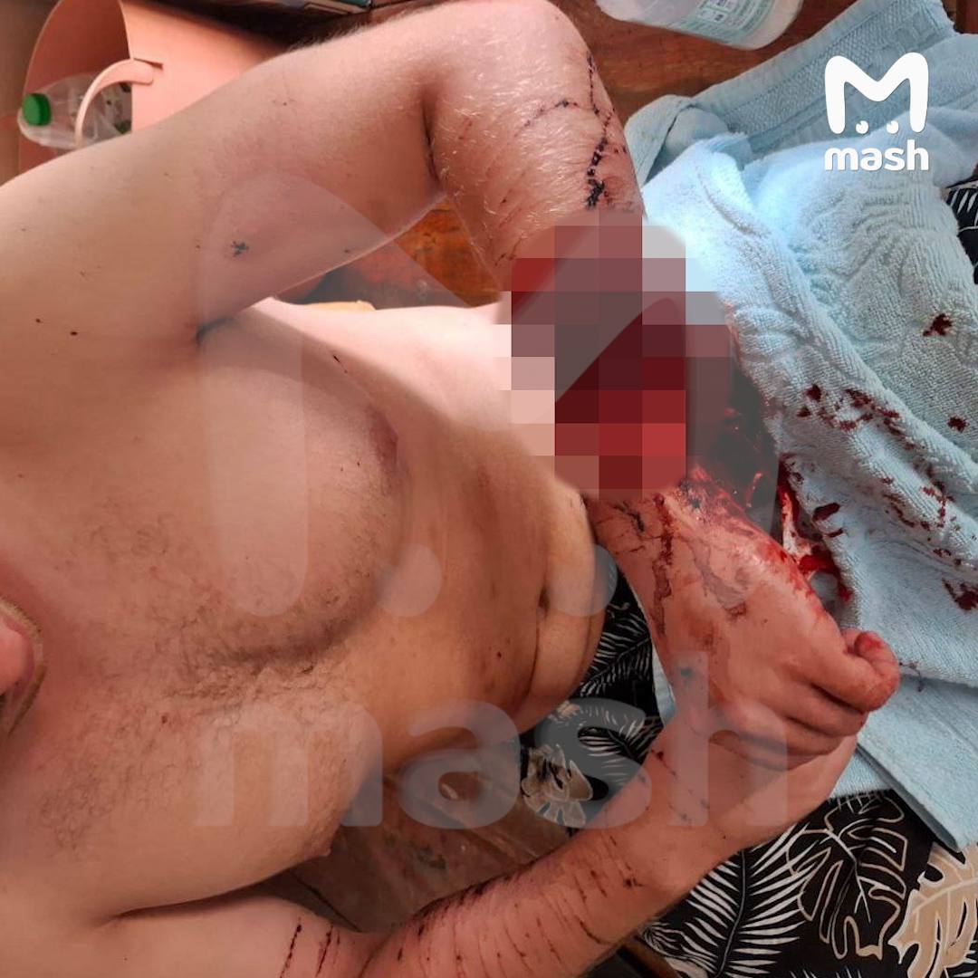 Российский релокант нанёс себе больше ста порезов в Таиланде из-за депрессии и выжил, несмотря на потерю литра крови Российский релокант нанёс себе больше ста порезов в Таиланде из-за депрессии и выжил, несмотря на потерю литра крови