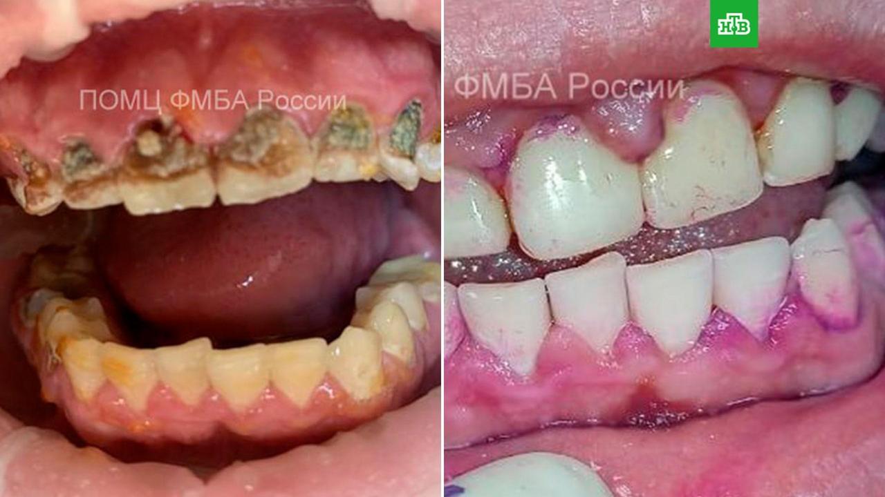Новая фобия: 18-летний парень из Нижнего Новгорода чуть не остался без зубов из-за энергетиков