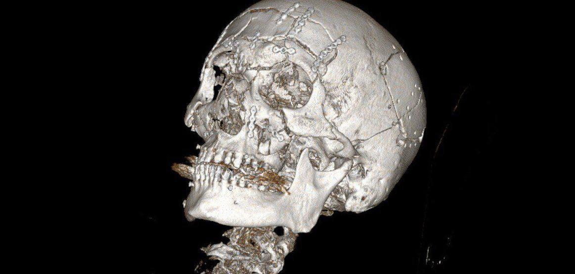 Врачи "собрали лицо" упавшего со снегохода мужчины в Жуковском, сообщил Минздрав Подмосковья Врачи "собрали лицо" упавшего со снегохода мужчины в Жуковском, сообщил Минздрав Подмосковья