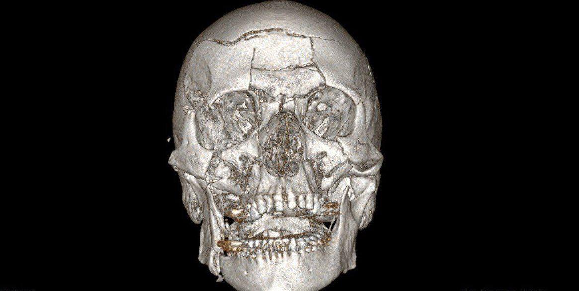 Врачи "собрали лицо" упавшего со снегохода мужчины в Жуковском, сообщил Минздрав Подмосковья