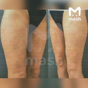 Ампутация ног грозит жительнице Краснодара после безобидной липосакции ягодиц