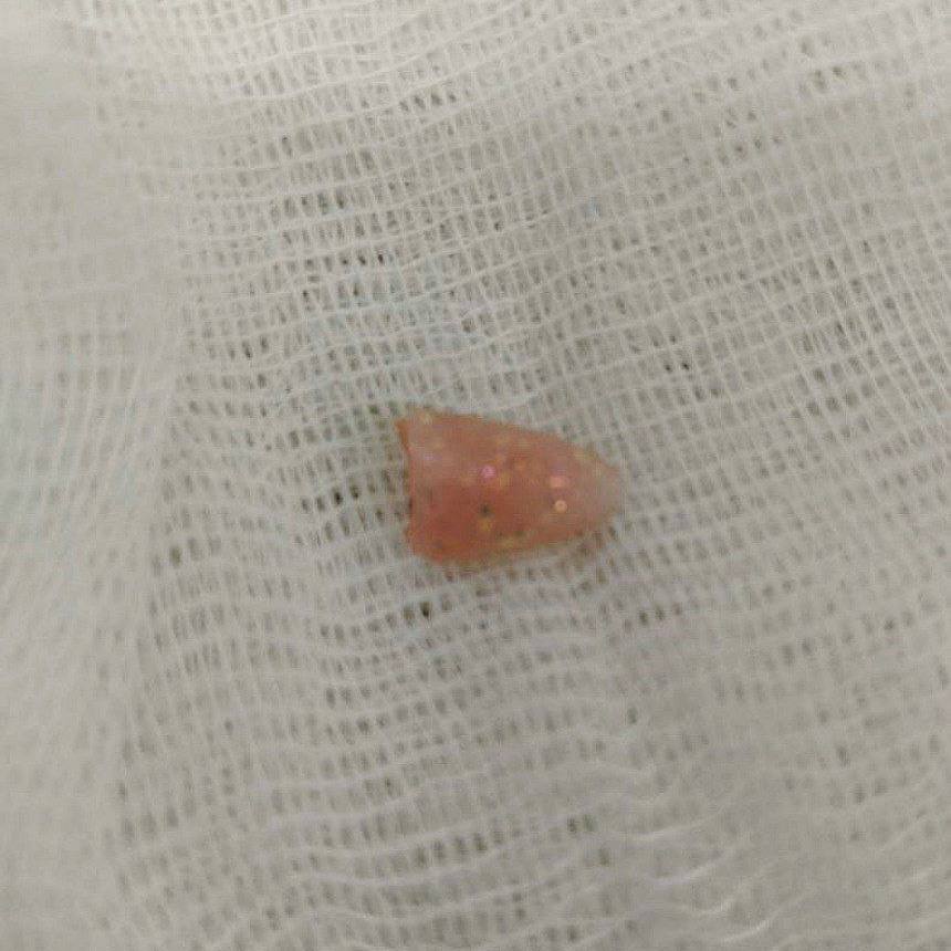 Накладной ноготь застрял в горле у 10-месячного малыша